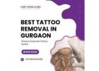 Remove Unwanted Tattoos Safely in Gurgaon